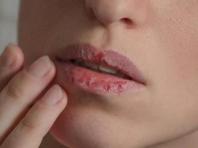 Dokter Gigi Peringatkan Bahaya Kondisi Mulut Kering