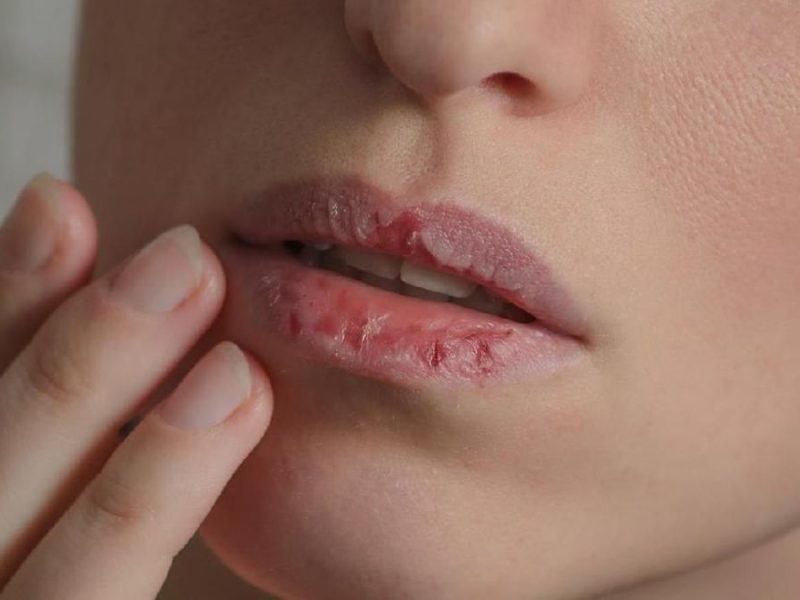 Dokter Gigi Peringatkan Bahaya Kondisi Mulut Kering