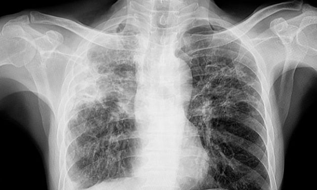 Fibrosis Paru, Penyakit Paru Kronis Yang Perlu Di Waspadai