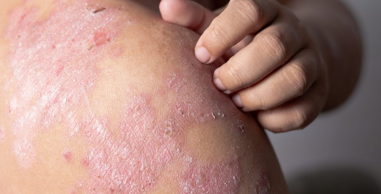 Penyakit Eksim Kondisi Peradangan Kronis Pada Kulit