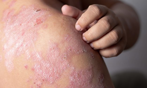 Penyakit Eksim Kondisi Peradangan Kronis Pada Kulit