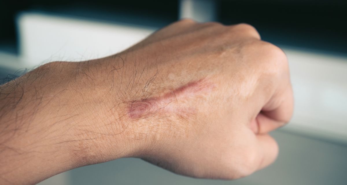 Benjol Keloid Bisa Turun-Temurun? Fakta Yang Harus Anda Tahu