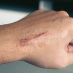 Benjol Keloid Bisa Turun-Temurun? Fakta Yang Harus Anda Tahu