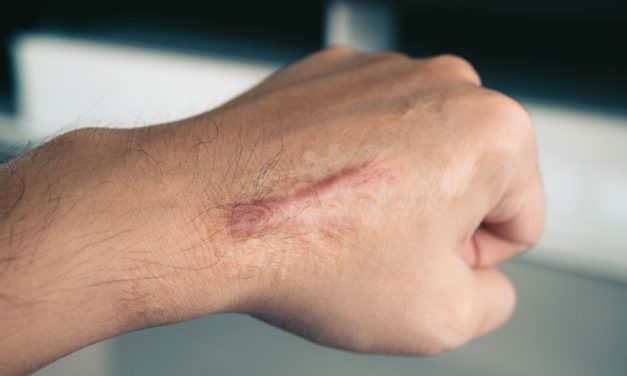 Benjol Keloid Bisa Turun-Temurun? Fakta Yang Harus Anda Tahu