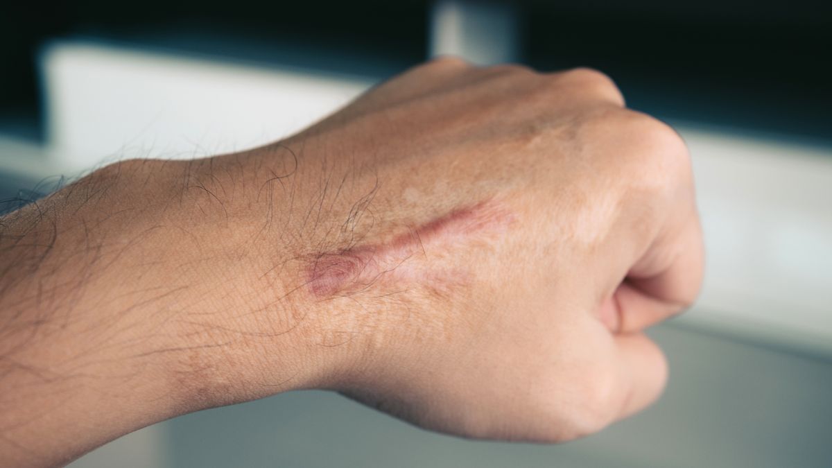 Benjol Keloid